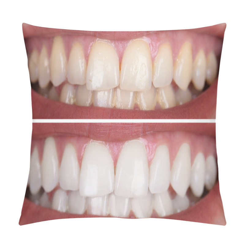 Personality  Close-up Of A Smiling Woman's Teeth Before And After Whitening Pillow Covers