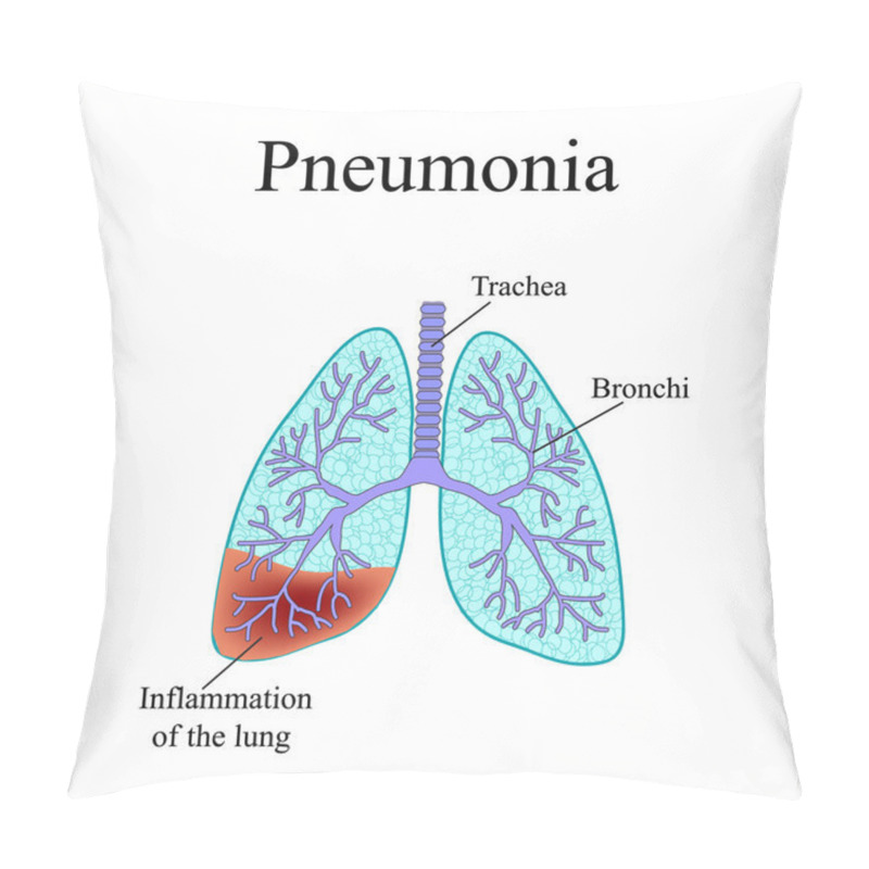 Personality  Pneumonia. The Anatomical Structure Of The Human Lung. Vector Illustration On Isolated Background Pillow Covers