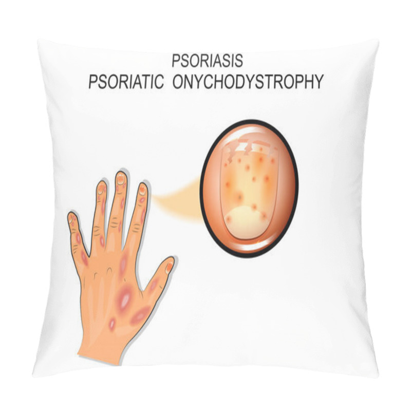 Personality  Psoriasis.  Psoriatic Onychodystrophy Pillow Covers