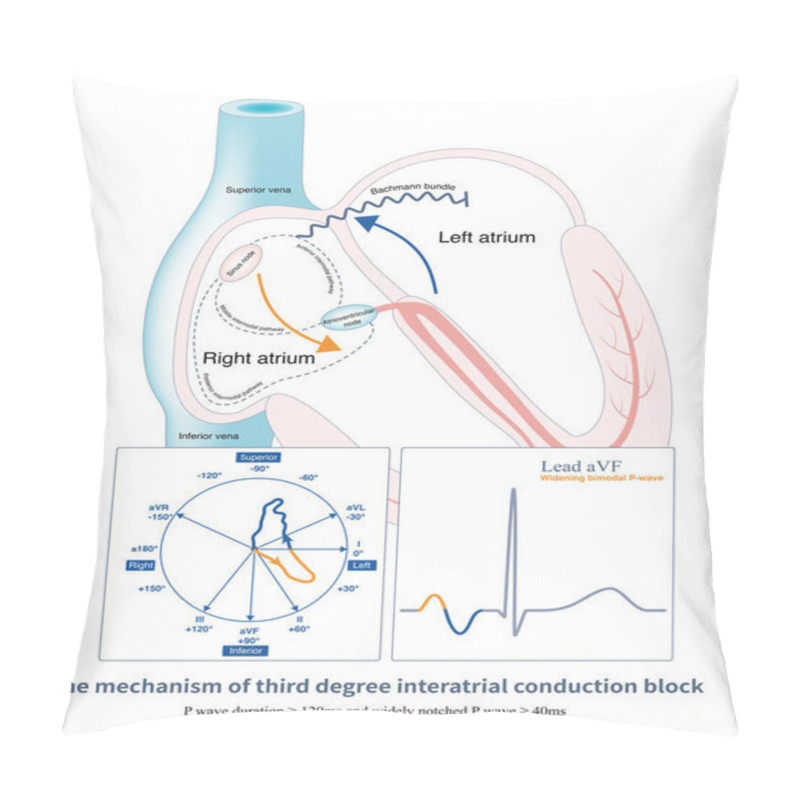 Personality  When Bachmann Bundle Conduction Is Interrupted, The Right Atrium Excites The Left Atrium Through The Coronary Sinus, Producing Positive And Negative Biphasic P-waves In The Inferior Leads. Pillow Covers