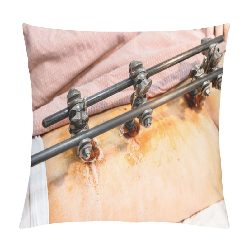 Personality  External Fixation Device On Hip And Pelvic In Patient With Pelvic Fracture (focus On Middle Screws) Pillow Covers