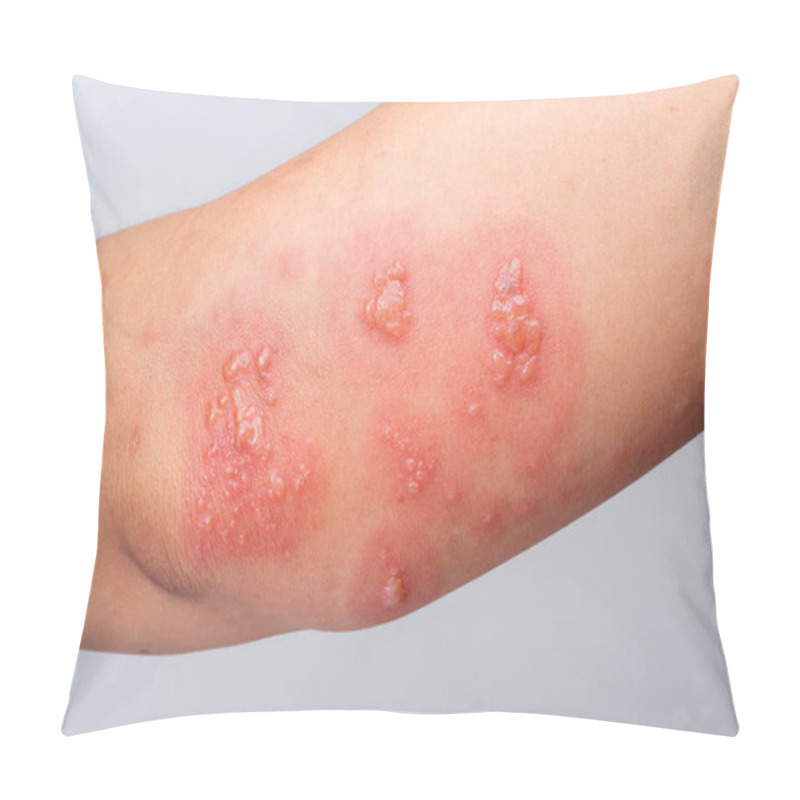 Personality  Shingles, Zoster Or Herpes Zoster Symptoms On Arm Pillow Covers