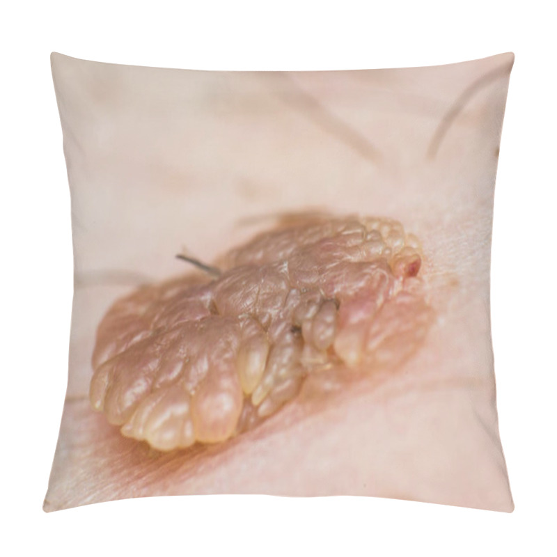 Personality  Macro Photo Of A Skin Wart, Papilloma Virus Infection Pillow Covers