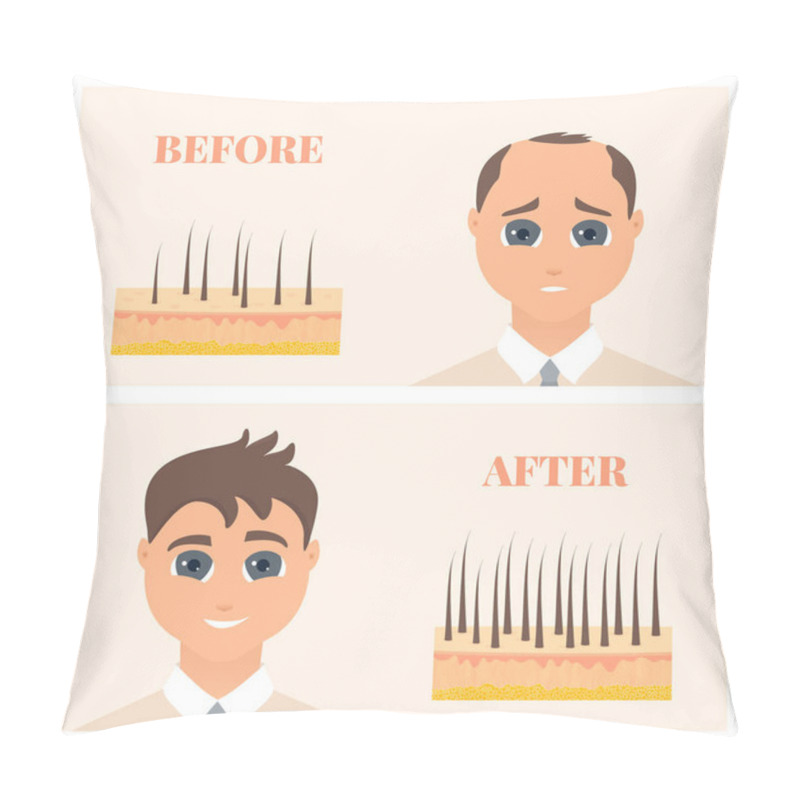 Personality  Male Pattern Alopecia Set. Medical Educational Poster. Pillow Covers