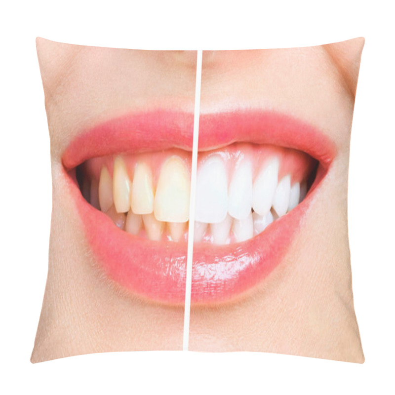 Personality  Woman Teeth Before And After Whitening. Over White Background Pillow Covers