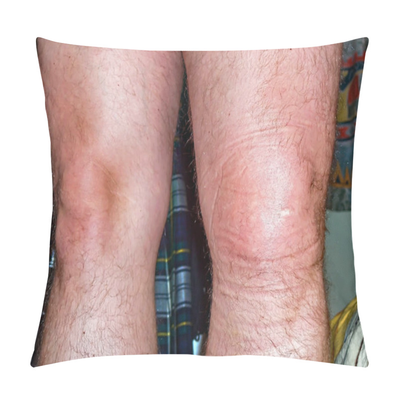 Personality  Swollen Left Knee Akter Ligament Rupture Ca 5 Hours After The Accident Pillow Covers