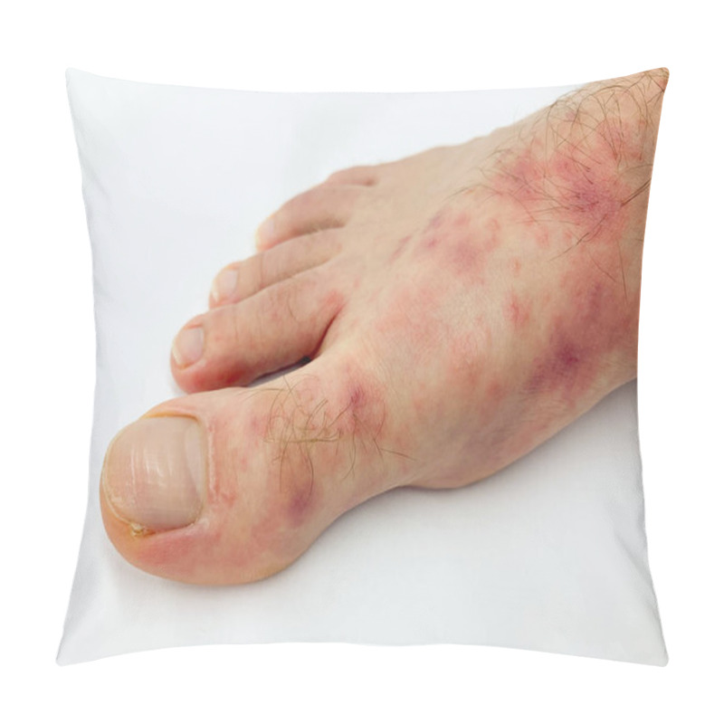 Personality  Close Up Of Male's Foot And Toes With Red Rash Desease On A White Background. Stock Image. Pillow Covers