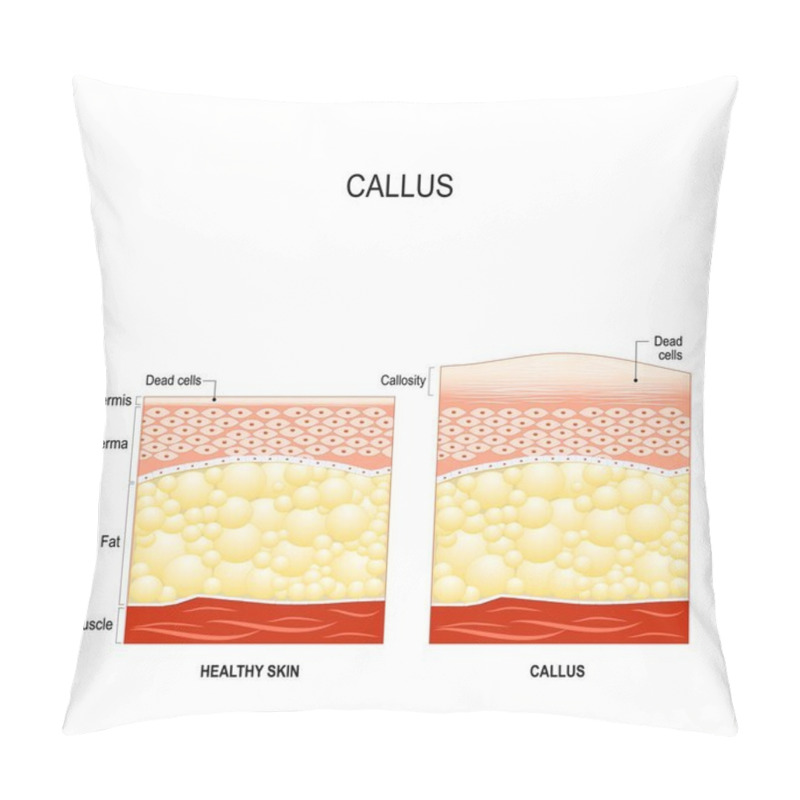 Personality  Callus. Callosity. The Difference Between Healthy Skin And Skin With Callus Pillow Covers