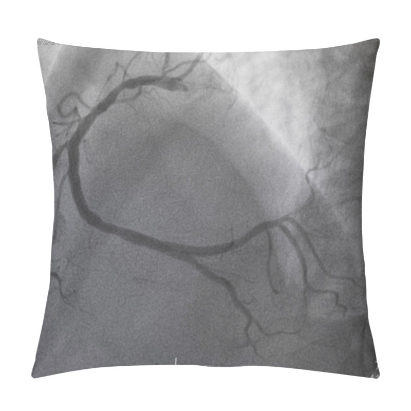 Personality  Coronary Angiography , Right Coronary Angiography Pillow Covers