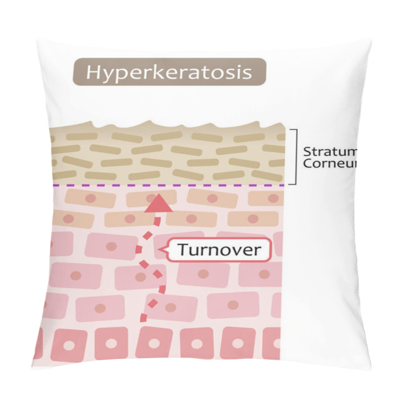 Personality  Diagram Of Skin Cell Turnover And Thickening Of The Stratum Corneum. Skin Care And Beauty Concept Pillow Covers