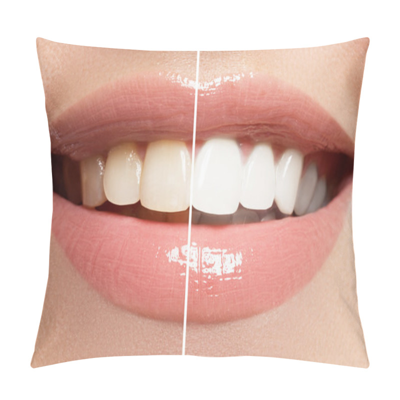 Personality  Perfect Smile Before And After Bleaching. Dental Care And Whitening Teeth Pillow Covers