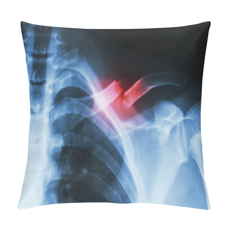 Personality  Fracture Left Clavicle Pillow Covers