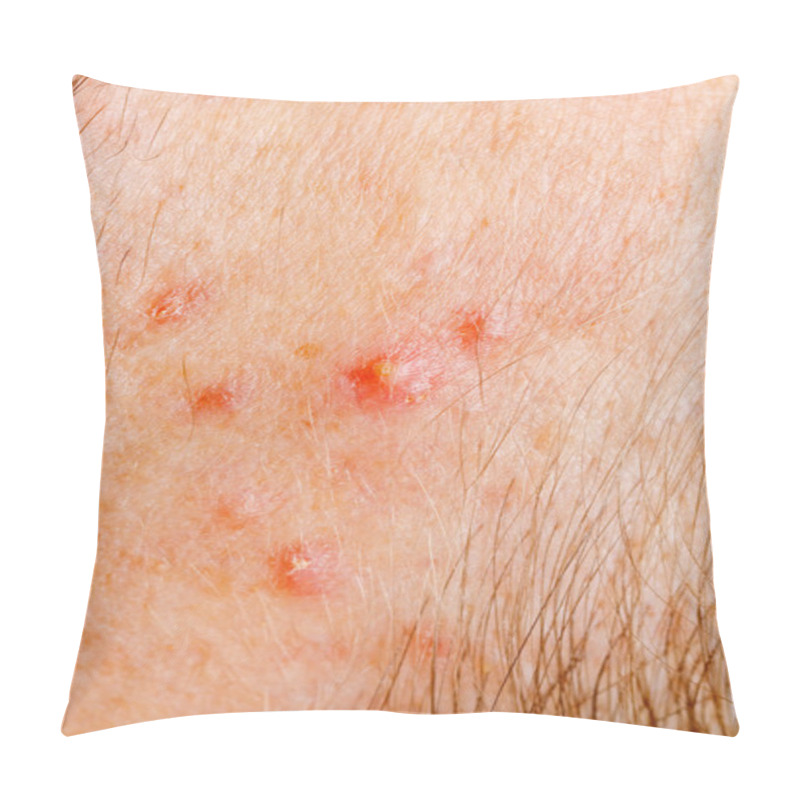 Personality  Pimple On Human Skin Macro Pillow Covers