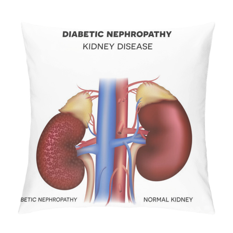 Personality  Diabetic Nephropathy, Kidney Disease Pillow Covers