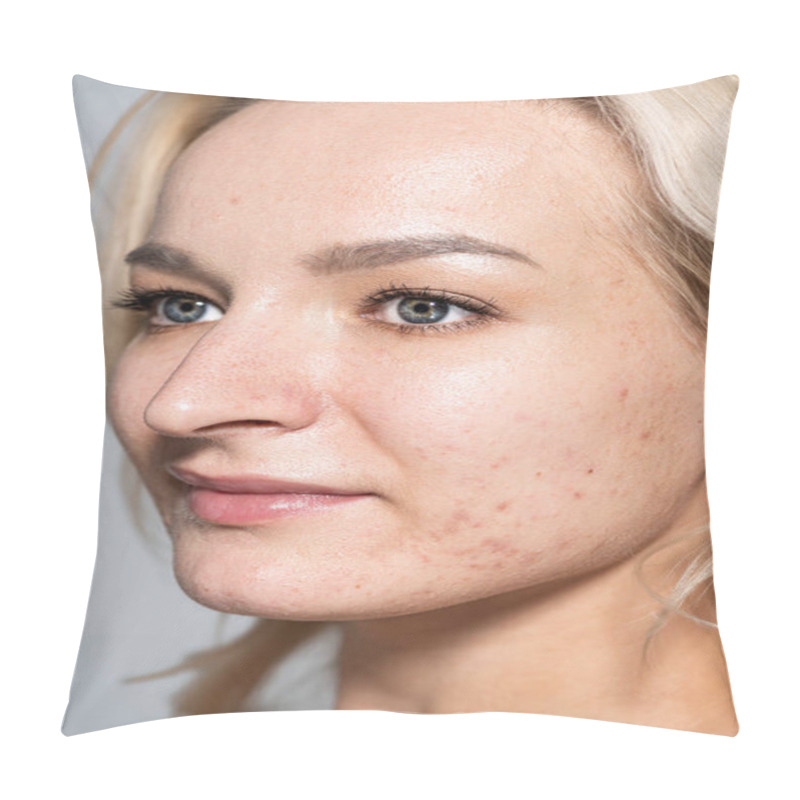 Personality  Close Up View Of Woman With Acne On Skin Looking Away Isolated On Grey  Pillow Covers