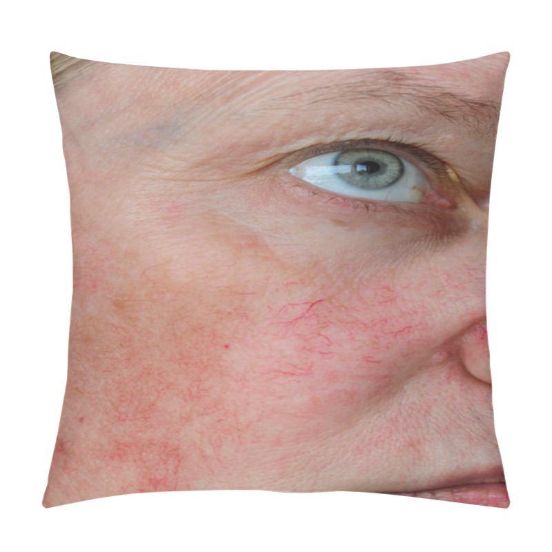 Personality  Woman Face Skin With Vascular Stars And Couperose. Pillow Covers