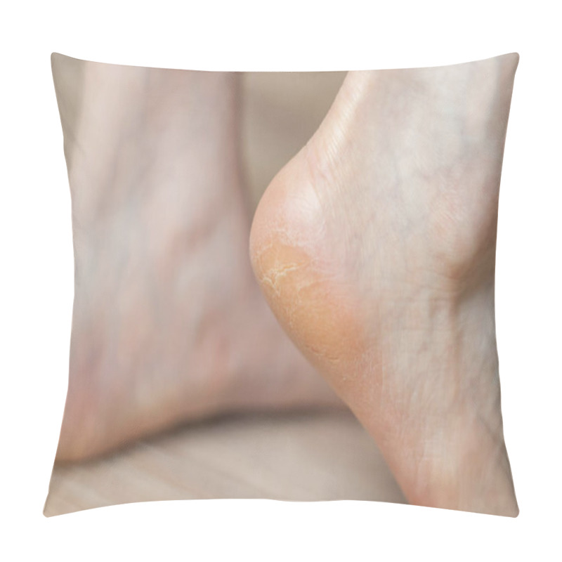 Personality  Clavus And Cracks On The Heel Of The Foot Pillow Covers