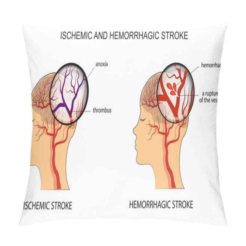 Personality  ISCHEMIC AND HEMORRHAGIC STROKE Pillow Covers