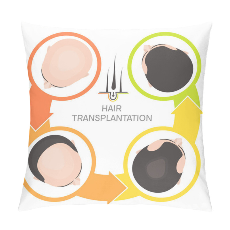 Personality  Hair Transplantation 4 Step Infographics Pillow Covers