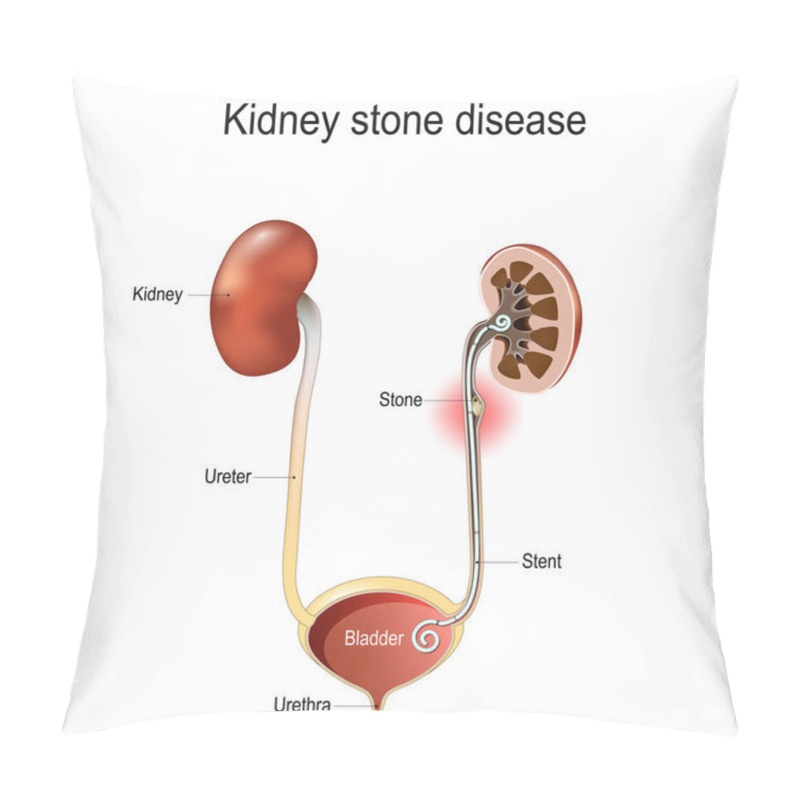 Personality  Kidney Stone Disease. Cross Section Of Ureter With Stone And Stent. Renal Calculi. Anatomy Of A Human Urinary System Includes The Kidneys, Ureters, Urinary Bladder, And Urethra. Vector Illustration Pillow Covers