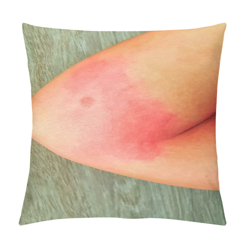 Personality  Red Rash Of The Patient Who Was Bitten By An Insect Pillow Covers