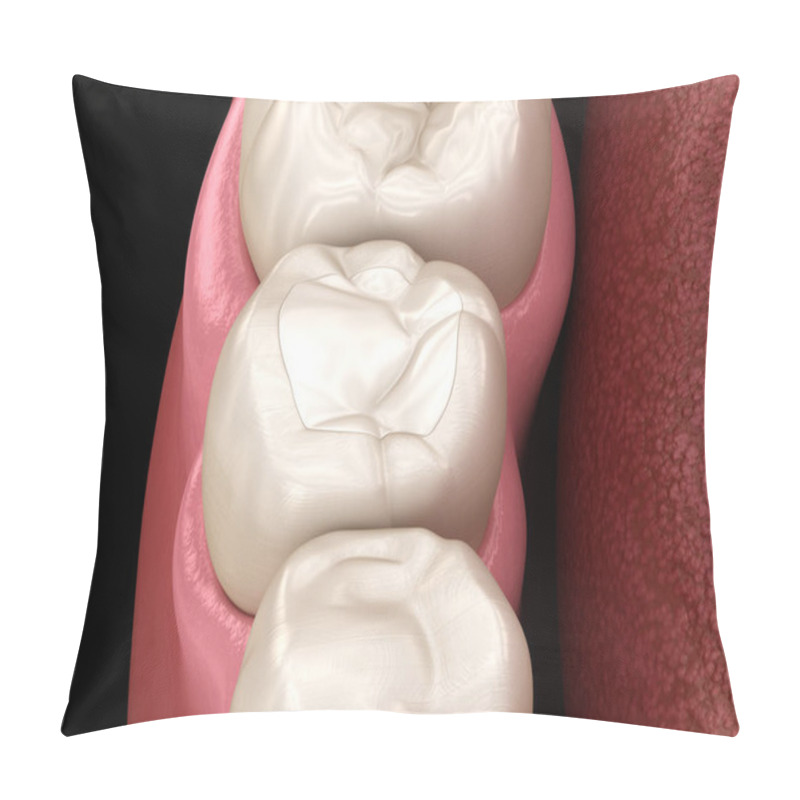 Personality  Premolar Tooth Restoration With Filling. Medically Accurate Tooth 3D Illustration. Pillow Covers