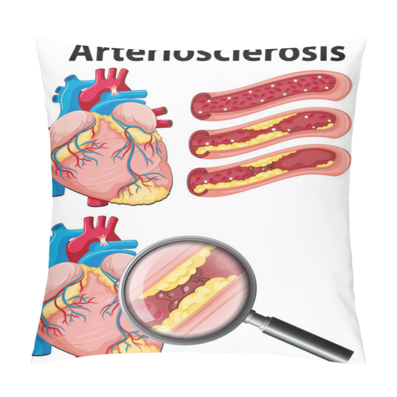 Personality  A Heart With Arteriosclerosis On White Background Illustration Pillow Covers