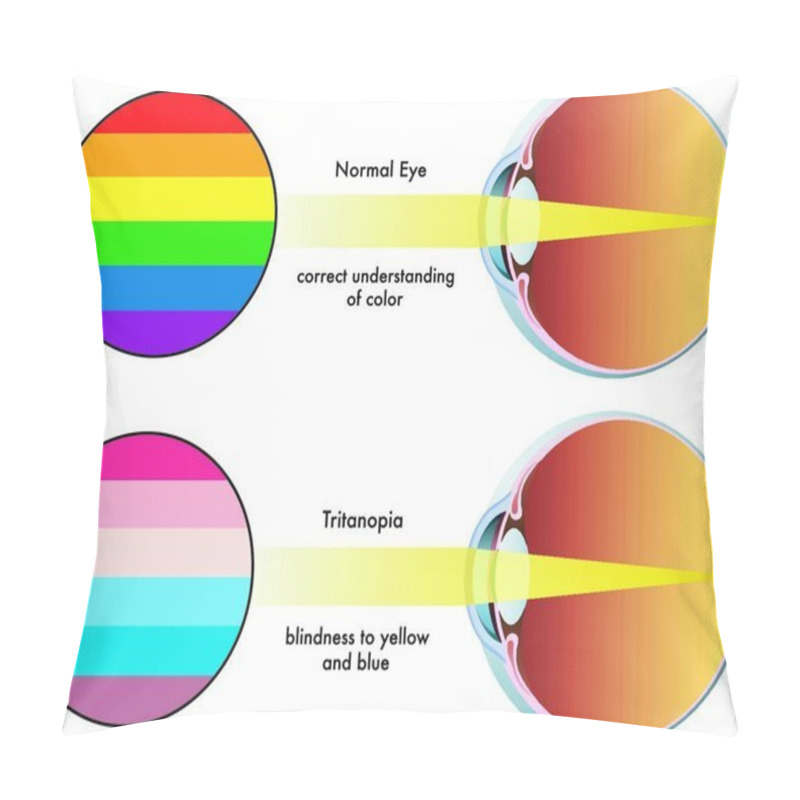 Personality  Vector Medical Illustration Of The Symptoms Of Tritanopia Pillow Covers