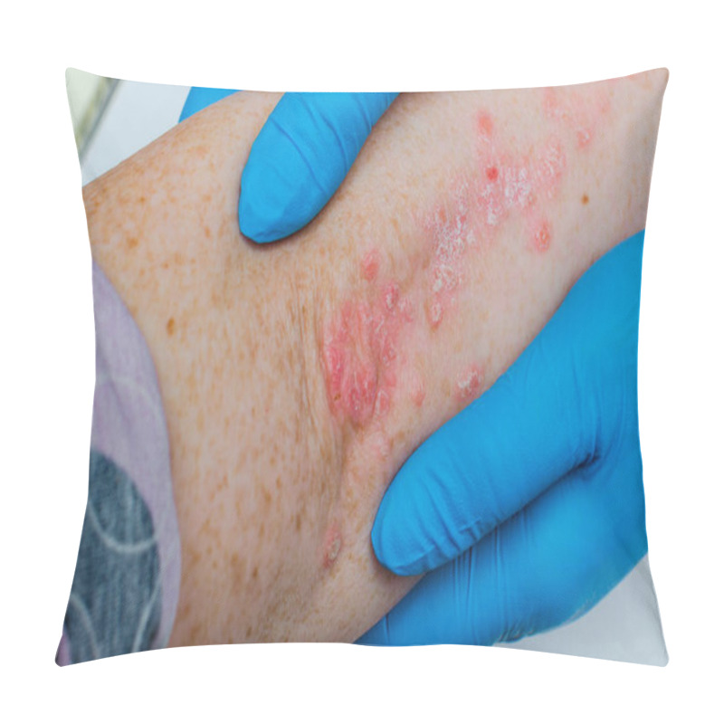 Personality  Diagnosis Of Skin Diseases - Allergies, Psoriasis, Eczema, Dermatitis. A Dermatologist With Gloves Examines The Skin Of The Elbow Of A Sick Patient. Pillow Covers