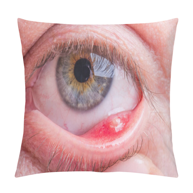 Personality  Stye (hordeolum) Disease On Eye Of A Caucasian Female Pillow Covers