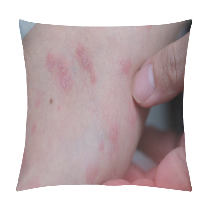 Personality  Man Hand Starting Suffering Of Prosiasis And Severe Urticaria Or Hives. Pillow Covers