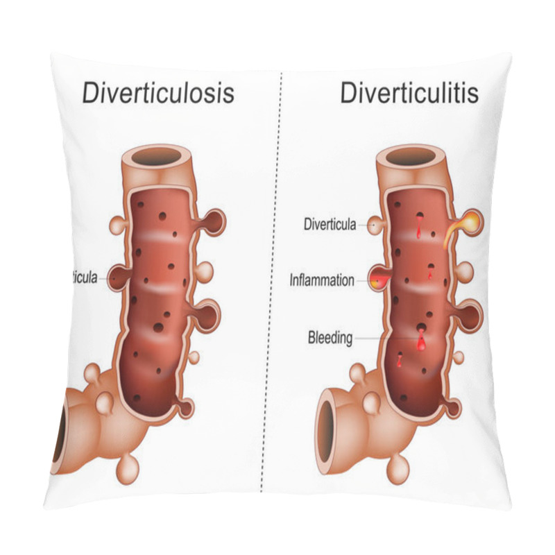 Personality  Difference Between Diverticulitis And Diverticulosis Colon. Close-up Of A Part Of A Large Intestine With Diverticula, Bleeding,  And Inflammation, Human Anatomy. Vector Illustration Pillow Covers