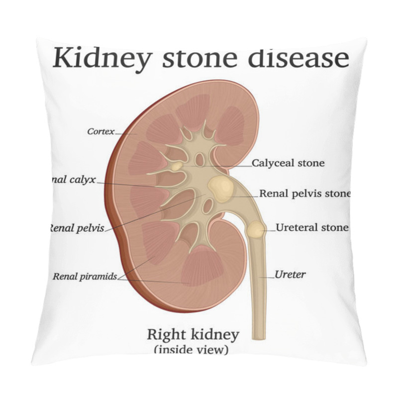 Personality  Illustration Of A Urological Disease Urolithiasis Also Known As Kidney Stone Disease. Shows The Location Of Stones In Different Parts Of The Kidney. Pillow Covers