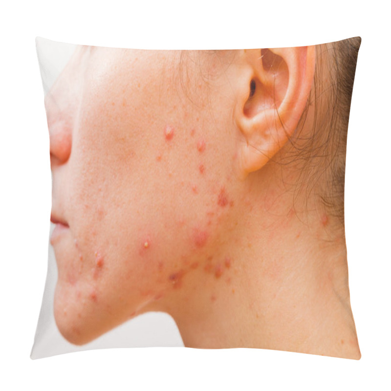 Personality  Acne Skin Pillow Covers