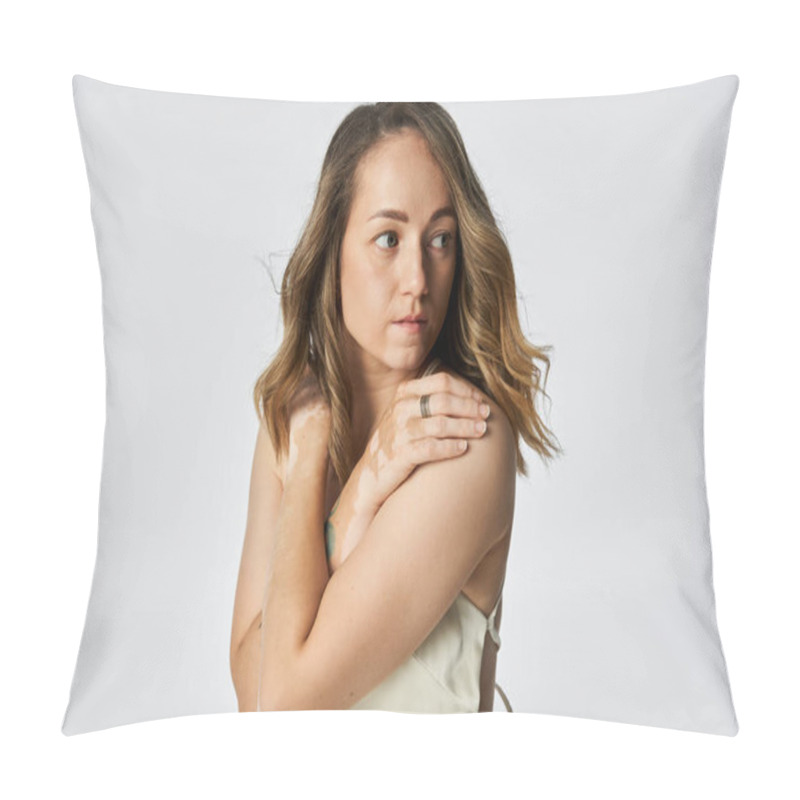 Personality  Beautiful Young Woman With Vitiligo Embraces Her Uniqueness While Posing Softly For The Camera. Pillow Covers