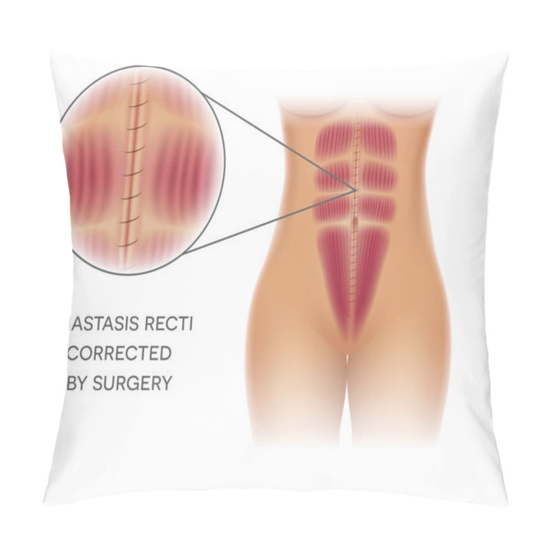 Personality  Diastasis Recti Also Known As Diastasis Rectus Abdominis Or Abdominal Separation, It Is Common Among Pregnant Women And Post Birth. After Surgery Correction.  Pillow Covers