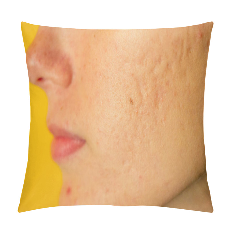 Personality  Post-acne, Scars And Red Festering Pimples On The Face Of A Young Woman. Concept Of Skin Problems And Harmonic Failure Pillow Covers