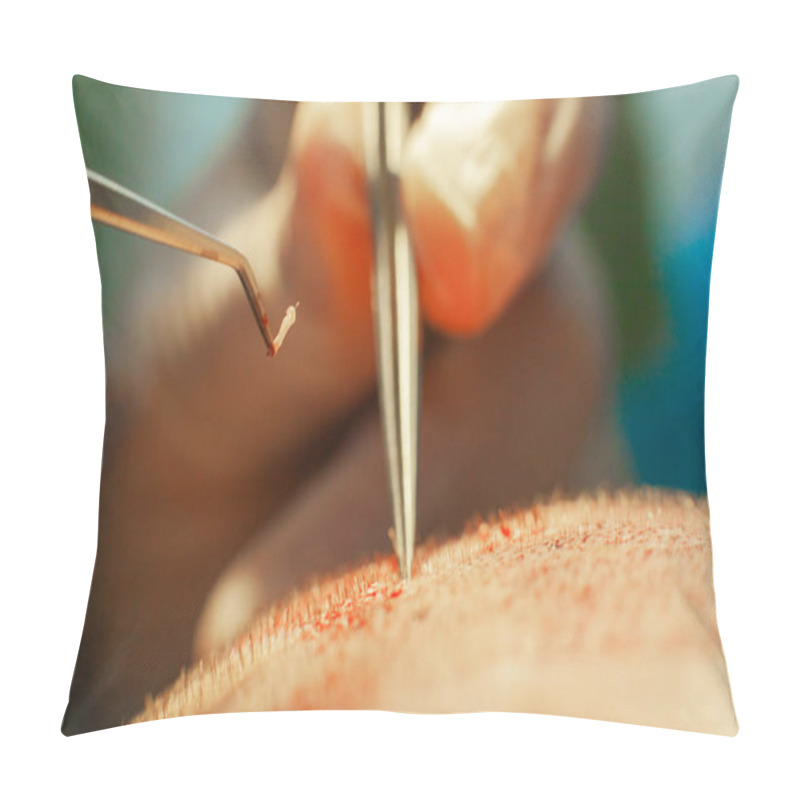 Personality  Macrophotography Of A Hair Bulb Transplanted Into A Hairless Area. Baldness Treatment. Hair Transplant. Surgeons In The Operating Room Carry Out Hair Transplant Surgery. Surgical Technique That Moves Pillow Covers