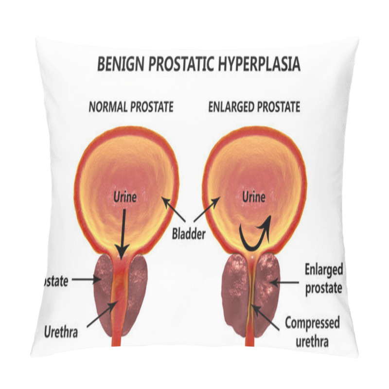 Personality  Benign Prostatic Hyperplasia Pillow Covers