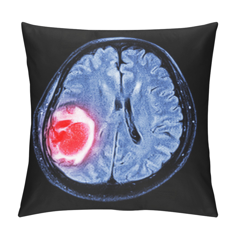 Personality  MRI Brain : Show Brain Tumor At Right Parietal Lobe Of Cerebrum Pillow Covers