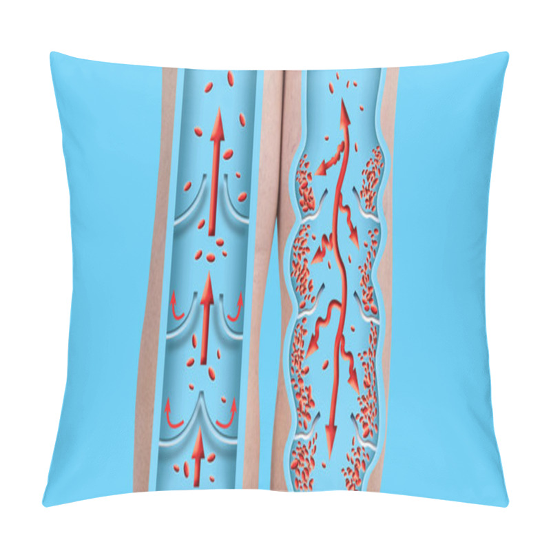 Personality  Varicose Veins, Vein Thrombosis  Pillow Covers