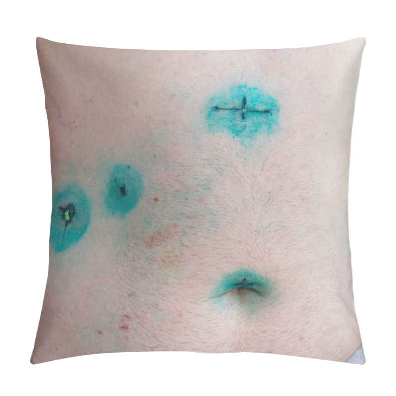 Personality  Male Body With Incisions After Gallbladder Laparoscopic Surgery Gallstones Endoscopy Removing. Cholecystectomy Small Cuts On Abdomen. Liver Dysfunction Icteruswith Bilirubin, Biliary Tract Obstruction Pillow Covers