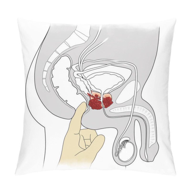 Personality  Manual Examination And Cross-sectional View Of Prostate Cancer Pillow Covers