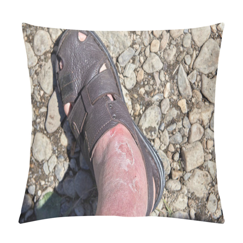 Personality  Skin Burn On The Foot And Ankle, Sunburn. Pillow Covers