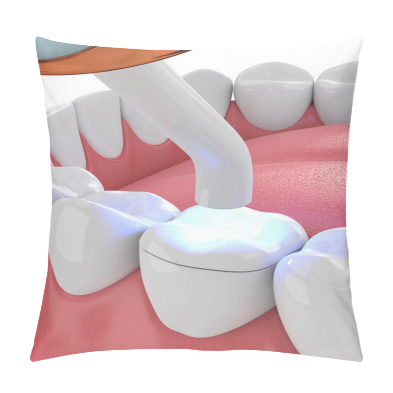 Personality  3d Render Of Jaw With Dental Polymerization Lamp And Light Cured Onlay Filling Over White Background Pillow Covers