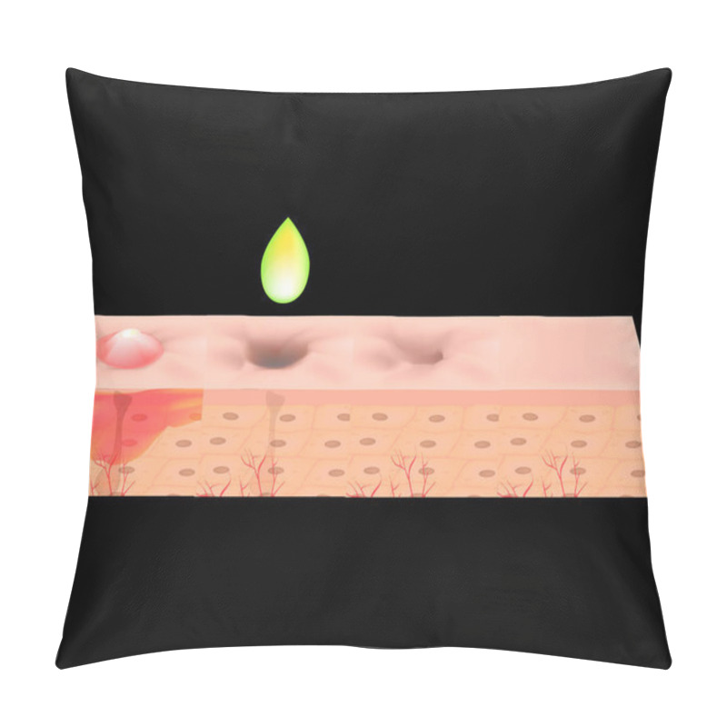 Personality  Atrophic Scars. Acne Scar. The Anatomical Structure Of The Skin With Acne. Vector Illustration. Pillow Covers