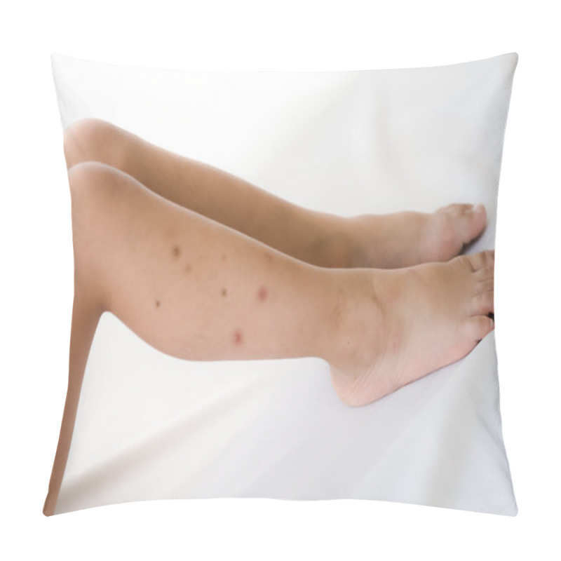 Personality  Mosquito Bites Sore On Baby Legs Pillow Covers