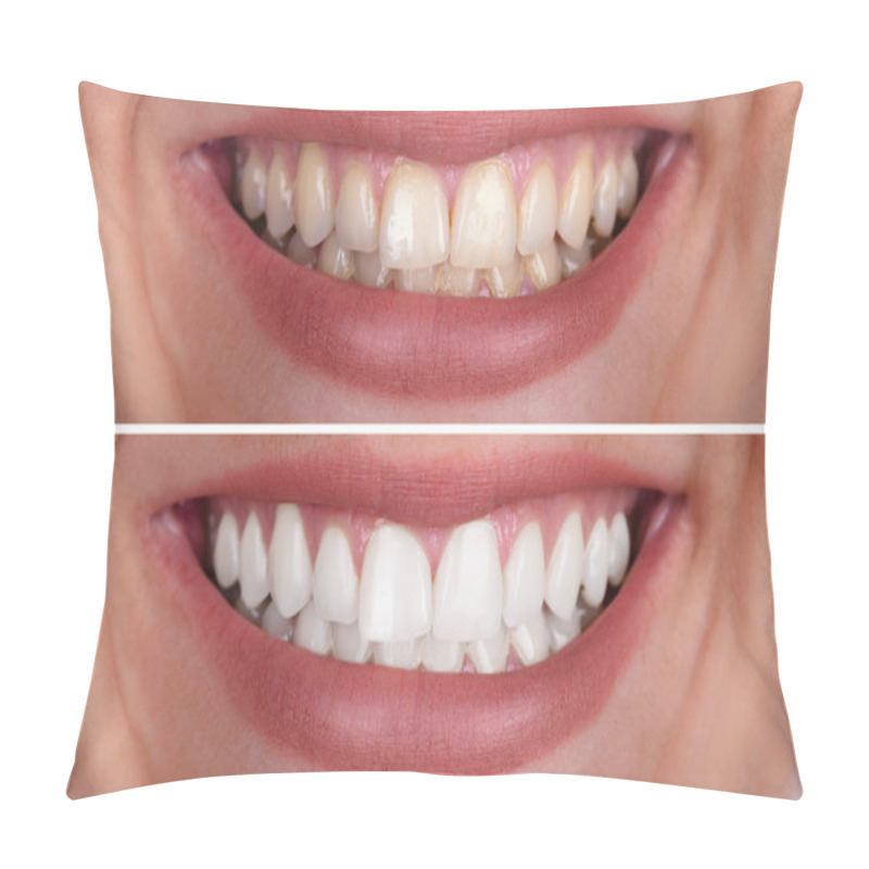 Personality  Close-up Of A Smiling Woman's Teeth Before And After Whitening Pillow Covers