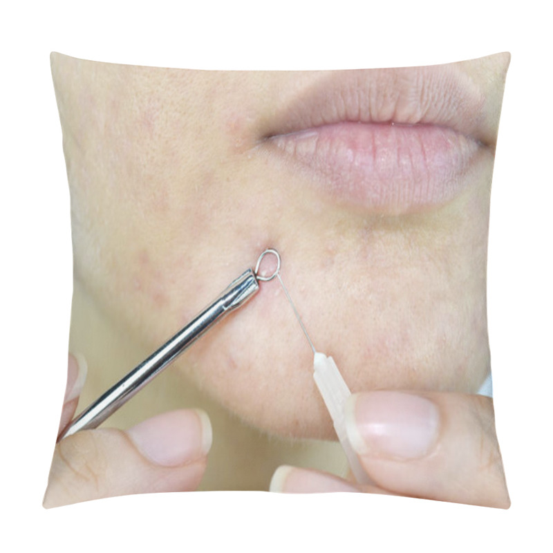 Personality  Skin Problem With Acne Diseases, Close Up Woman Face Squeezing Whitehead Pimples On Chin With Acne Removal Tool, Scar And Oily Greasy Face, Beauty Concept. Pillow Covers