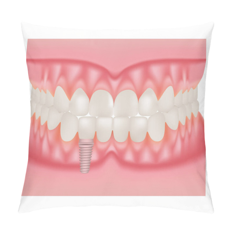 Personality  Human Jaw Model With Teeth And Implant. Installation Of Dental Implants Isolated On A White Background. Vector Illustration. Pillow Covers